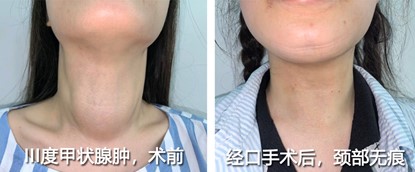 图1 III度甲状腺肿大患者术前与经口手术后对比照。